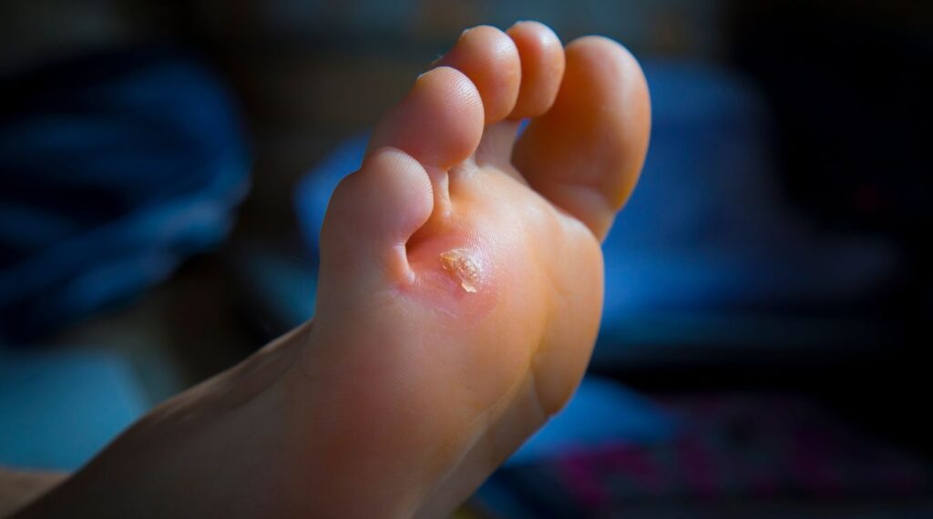 Callo plantar en la planta del pie