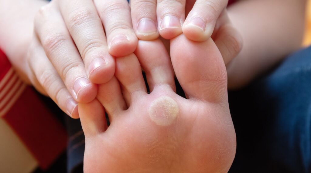 Callosidad plantar entre los dedos